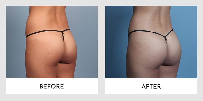 Brazilian Butt Lift Before and After Photos Page 05 - Beverly Hills